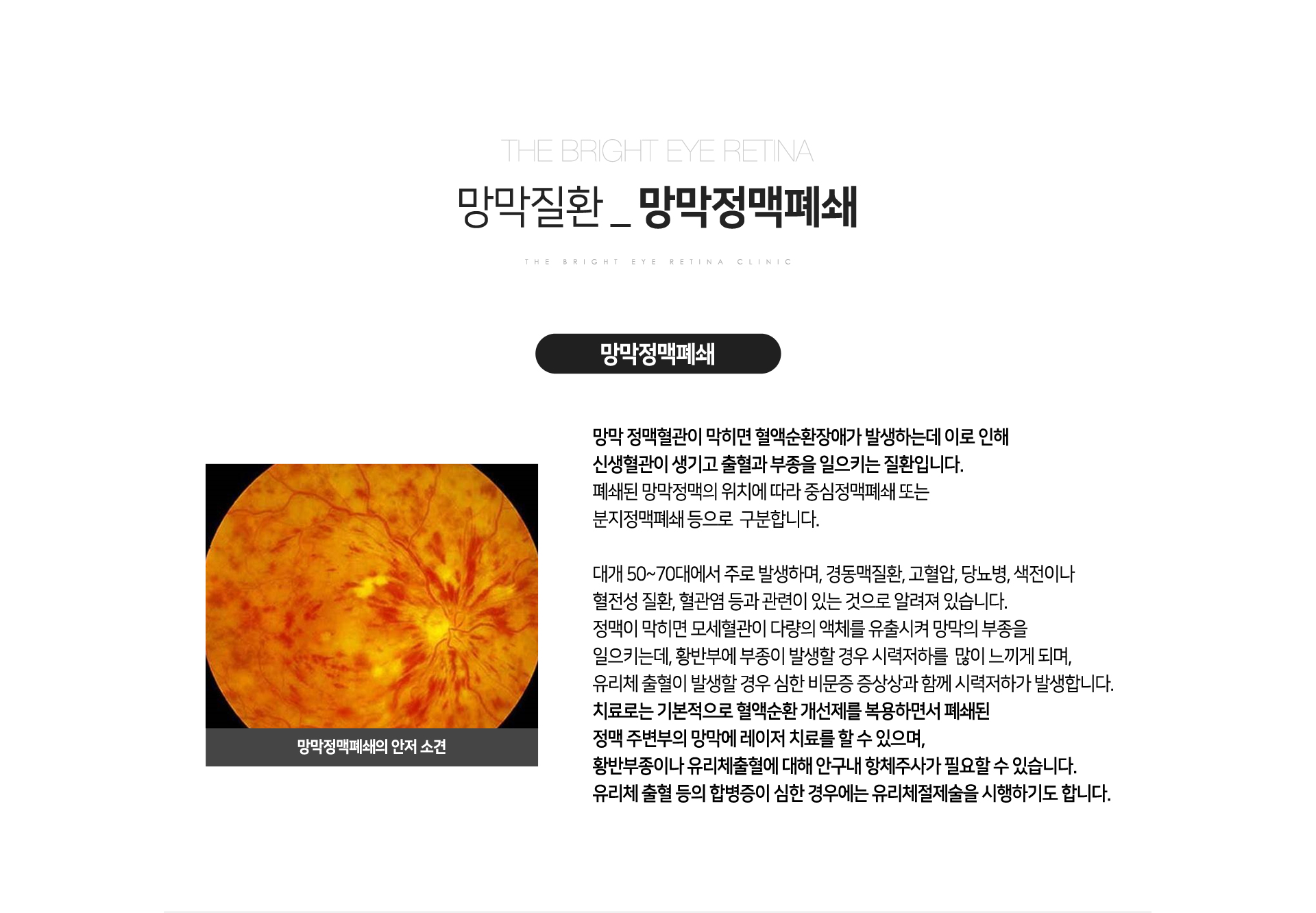 망막정맥폐쇄