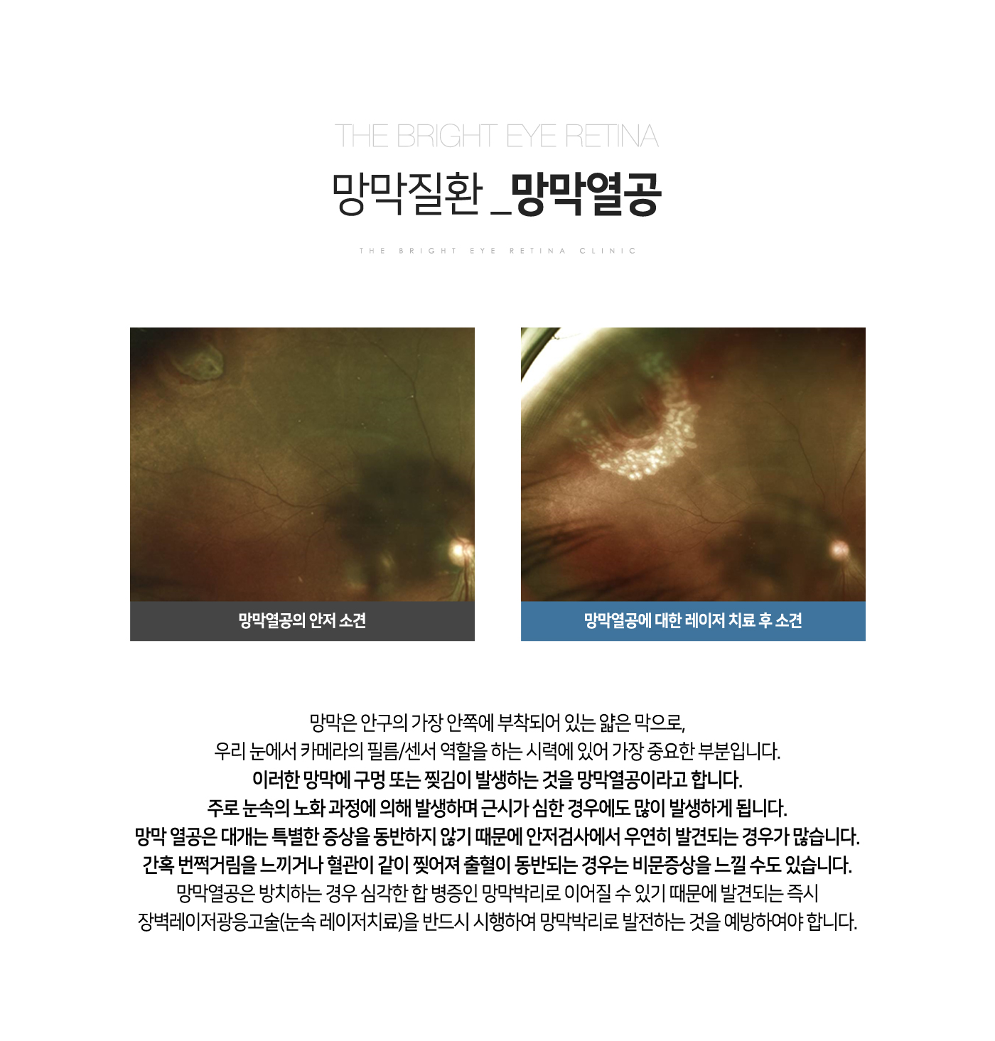 망막열공